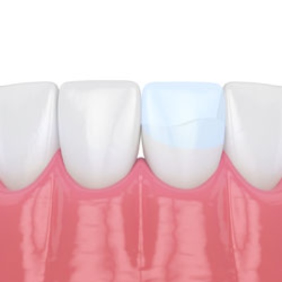 Dental Bonding Treatment