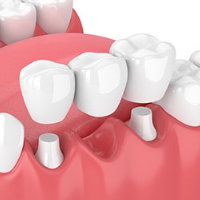Dental bridge replacing a missing tooth