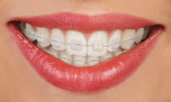 Clear braces for discreet teeth straightening