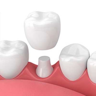 Dental crown used to restore a damaged or weakened tooth