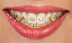 Gold braces for orthodontic teeth straightening