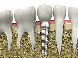 Dental implant model showing the implant post and replacement tooth