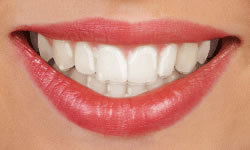 Clear Invisalign aligners for straightening teeth
