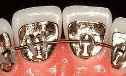 Lingual braces attached to the back surfaces of teeth