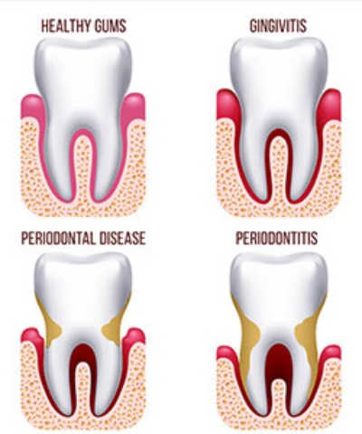 Periodontal treatment for maintaining healthy gums and supporting teeth