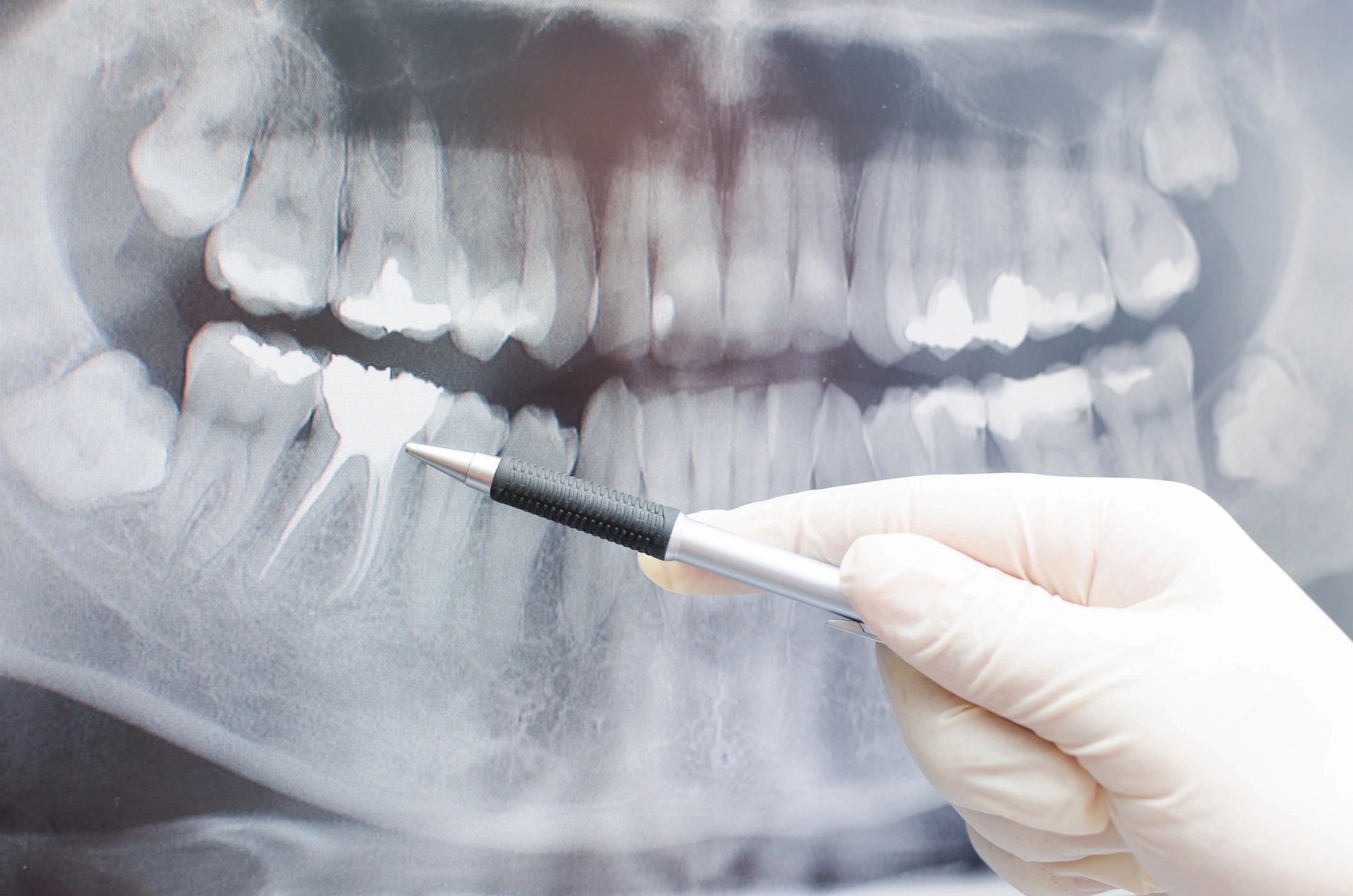 Dental X-ray showing teeth during a professional dental examination
