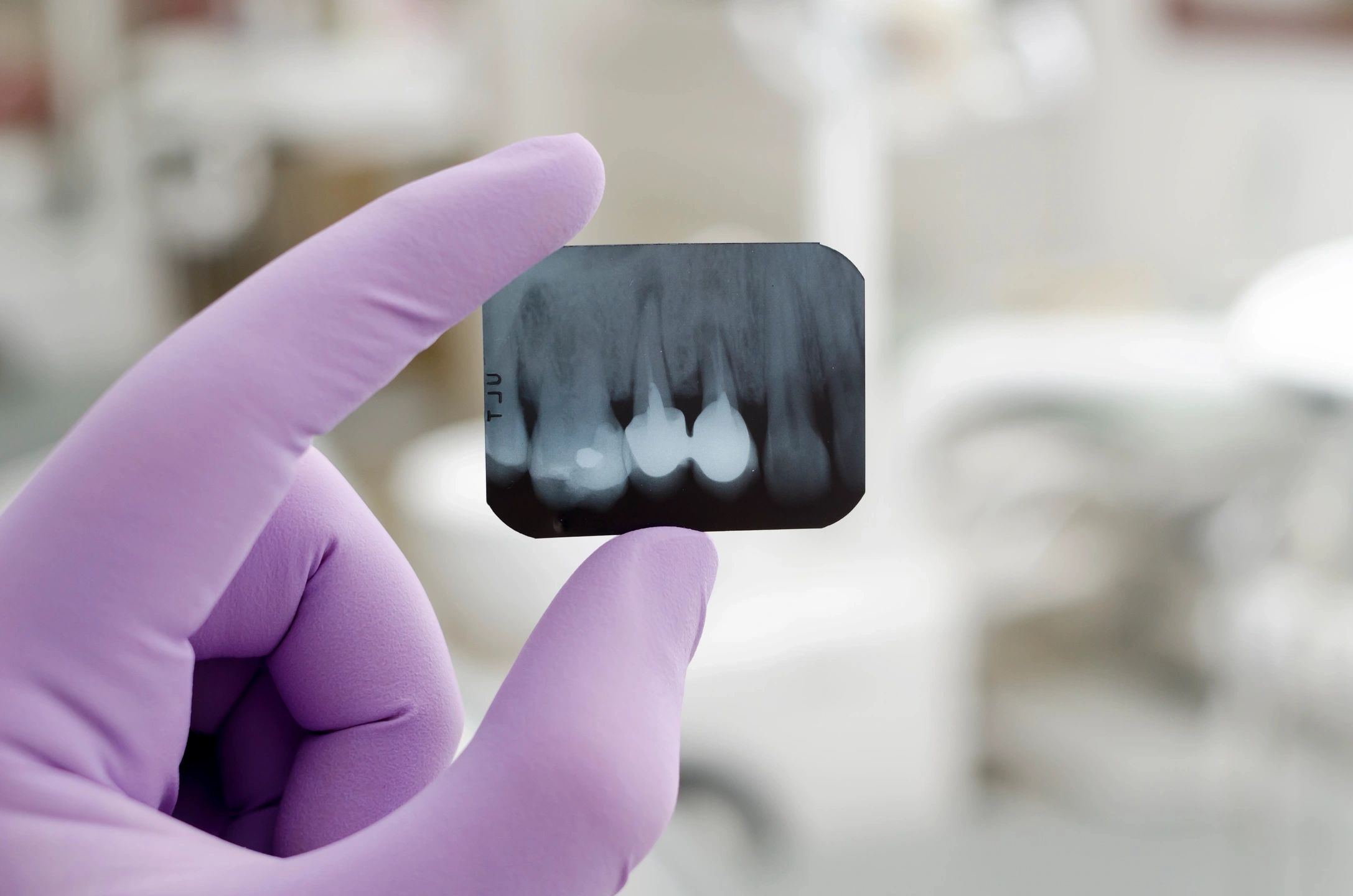 Dental X-ray showing teeth and dental restorations