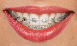 Traditional metal braces for straightening teeth