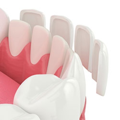 Dental veneers designed to improve the appearance of teeth
