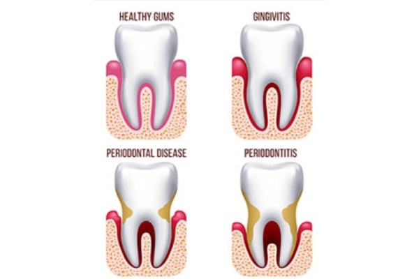 Gum Disease in Brooklyn, NY